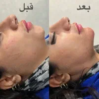 جشنواره پاییزه زیبایی ژل بوتاکس لیزر مزو|خدمات آرایشگری و زیبایی|رشت, نامجو|دیوار