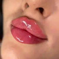 تزریق ژل(فیلر)و بوتاکس