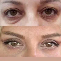 بلفارو پلک فیلر ژل لب ساکشن غبغب بوتاکس نخ سانترال|خدمات آرایشگری و زیبایی|اصفهان, مرداویج|دیوار