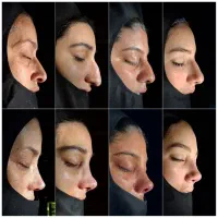 جراحی زیبایی بینی با خفیف ویژه تا انتهای شهریور