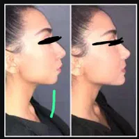 تخفیف فیلر صورت|خدمات آرایشگری و زیبایی|اهواز, زیتون کارمندی|دیوار