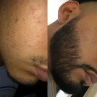 رویش ریش و سبیل