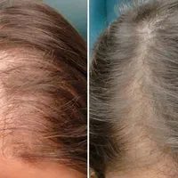 راهکار طبیعی برای بهبود ریزش مو و رویش مجدد آن