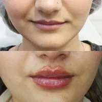 تزریق ژل بوتاکس مزو کارگذاری نخ توسط پزشک در مطب