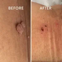 پاکسازی تخصصی و خال برداری تخصصی با دستگاه