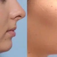 ژل و بوتاکس