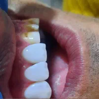 ایمپلنت(کاشت دندان)و کلیه خدمات دندانپزشکی