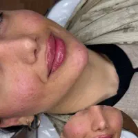 آموزش فقط ۵ میلیون و خدمات ژل بوتاکس
