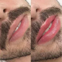 رفع تیرگی لب آقایون(دارک لیپس‌)