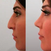 جشنواره عمل بینی فقط (۳۵) توسط متخصص|خدمات آرایشگری و زیبایی|شاهین‌شهر, فردوسی|دیوار