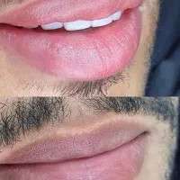 انجام میکرو و رفع تیرگی