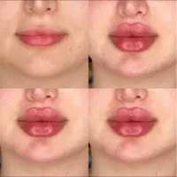 ژل وبوتاکس ولیزر(جشنواره ۵۰ درصدی)