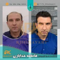 جشنواره عیدانه کاشت مو، ابرو، پی ار پی تخفیف ویژه