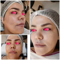 آموزش مزو نیدلینگ +تکنیک پوست کره ای+کاموفلاژ بدن|خدمات آموزشی|مشهد, هنرستان|دیوار