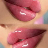 ژل لب-فیلر لب (فیلر لب روسی)