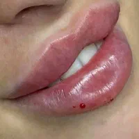 ژل و بوتاکس هر سی‌سی ۶۰۰ در کلینیک