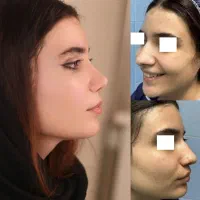 عمل جراحی تخصصی بینی،تخفیف ویژه