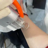 کندلا شاتی ۲۰۲۶با ریزش تضمینی تحت نظر پزشک