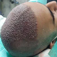 تخفیف ویژه کاشت مو و ابرو|خدمات آرایشگری و زیبایی|کرمانشاه, |دیوار