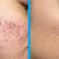 فشیال پوست تقویت مو درمطب پزشک ویژه بانوان وآقایان|خدمات آرایشگری و زیبایی|شیراز, رازی|دیوار