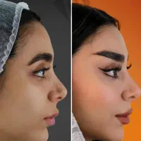 تخصص حرفه ای تزریق لب روسی|خدمات آرایشگری و زیبایی|ارومیه, |دیوار