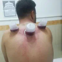 حجامت درمانی ، زالو درمانی