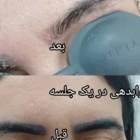 لیزر پاک کردن تتو ابرو و بدن و خالکوبی قدیمی|خدمات آرایشگری و زیبایی|اهواز, اهواز|دیوار