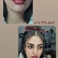 جشنواره یلدایی ژل و بوتاکس|خدمات آرایشگری و زیبایی|آمل, |دیوار