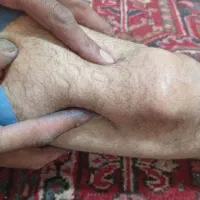 راهنمایی در مورد توده در کنار زانو