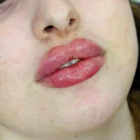 فیلر بوتاکس لیزر فیلربادی لاغری مزوتراپی prp جراحی|خدمات آرایشگری و زیبایی|مشهد, هنرستان|دیوار