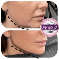 فیلر بوتاکس متخصص زیبایی|خدمات آرایشگری و زیبایی|تبریز, |دیوار