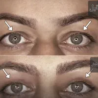 جشنواره تخفیف بلفاروپلاستی(جراحی پلک)|خدمات آرایشگری و زیبایی|شاهینشهر, فردوسی|دیوار