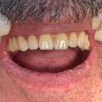 دندان مصنوعی با بیمه تامین اجتماعی اقساط|خدمات زیبایی و سلامت|تهران, آشتیانی|دیوار