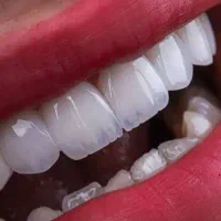 دندان بدون کام طرح لمینیت درمحلات، یکروزه ارزان