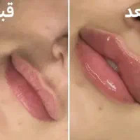 ساکشن چربی ژل وبوتاکس