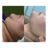 ساکشن غبغب،جراحی بلفاروپلاستی|خدمات آرایشگری و زیبایی|شهرکرد, |دیوار