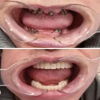 دندانپزشکی لمینت اقساط زیبائی کامپوزیت ارتودنسی