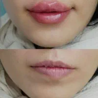 ژل لب،چونه ،آنزیم ،زاویه ،بوتاکس|خدمات آرایشگری و زیبایی|قم, تولید دارو و یخچال|دیوار