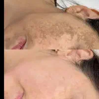 رفع کک،مک صورت دردوجلسه،فیلر،بوتاکس درسهند و تبریز