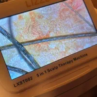 درمان ریزش موی سر، اسکراب اسکالپ