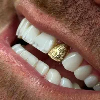 کامپوزیت دندانپزشکی تخفیفه ویژه اقساط چکی|خدمات آرایشگری و زیبایی|تهران, شهرک ولیعصر جنوبی|دیوار