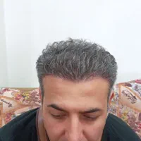 جشنواره کاشت مو و ابرو|خدمات آرایشگری و زیبایی|تهران, افسریه شمالی|دیوار