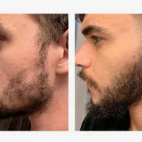 درماژن ریش