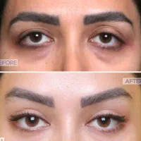 بلفارو و پیکرتراشی با تخفیف ویژه