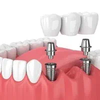(آف ویژه) کامپوزیت و ایمپلنت دندان اقساطی