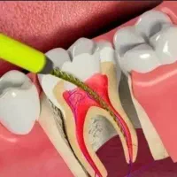 عصب کشی دندان های مولر (کرسی)