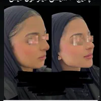 بوتاکس پیشانی و خط اخم رایگان شد توسط پزشک|خدمات آرایشگری و زیبایی|کاشان, بهشتی|دیوار