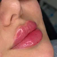 تزریق فیلر و بوتاکس