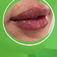 تزریق ژل و بوتاکس