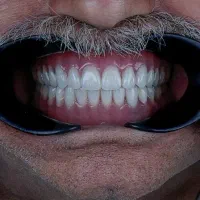 ساخت و تعمیر دندان مصنوعی/مواد آلمانی/نقد و اقساط|خدمات آرایشگری و زیبایی|چناران, |دیوار